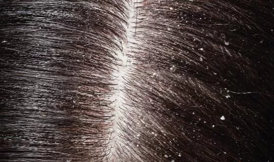 头皮屑多是什么原因引起的