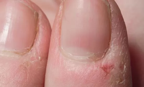 倒刺虽小处理不好会出大问题 预防倒刺有妙招